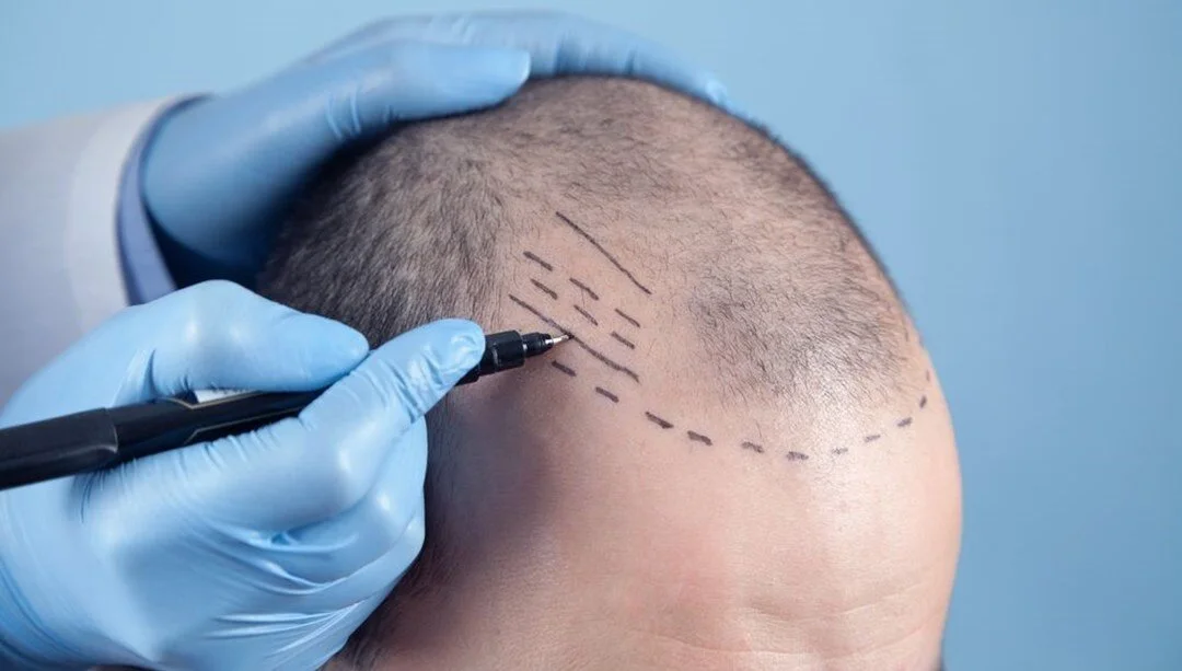 FUE Hair Transplant